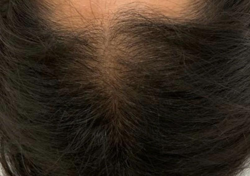 exosomes hair client after