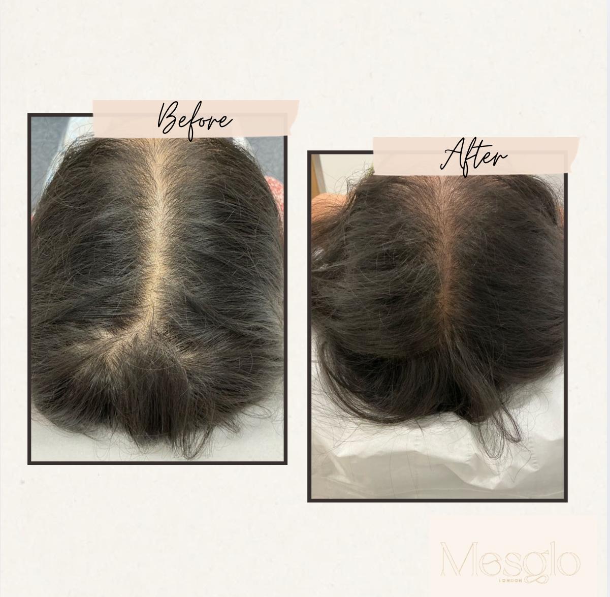 EXOSOME HAIR 13 exosomes hair before and after