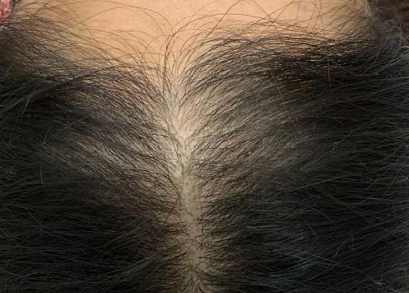 exosomes hair client before