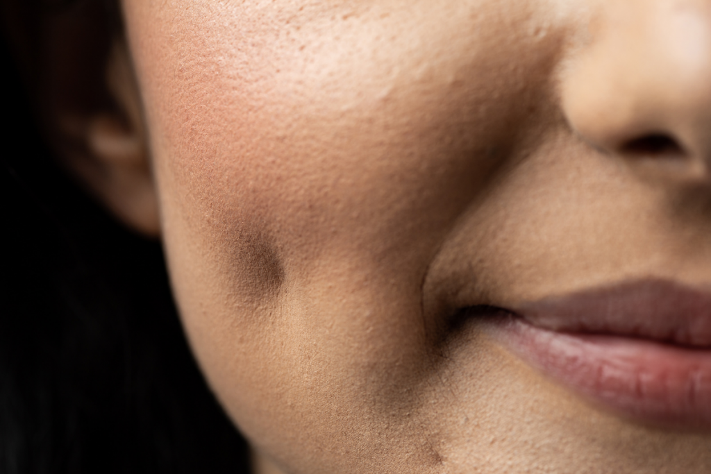 Cheek Enhancement: Creating Natural Definition and Youthful Volume